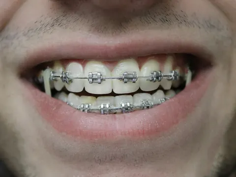 Smile with metal braces