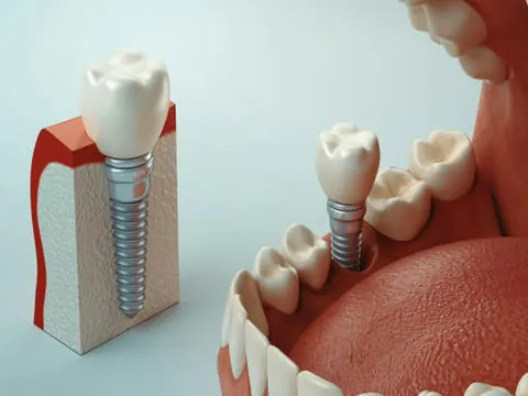 Model of a dental implant and crown